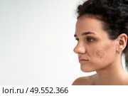 Close-up of a young girl with skin problems. Pimples, acne, pores, scars. Natural skin with and without filters. A place for your text. Стоковое фото, фотограф Корчагина Анастасия / Фотобанк Лори
