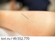 Close-up of a needle doing a dry needling in a physiotherapy center.. Needle of physiotherapist doing a dry needling. Стоковое фото, агентство Ingram Publishing / Фотобанк Лори