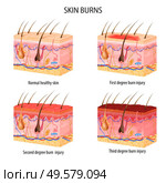 Realistic set of normal and three degree of burns skin structure isolated on white background vector illustration. Стоковая иллюстрация, агентство Ingram Publishing / Фотобанк Лори