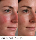Changes in skin tone during a dermatological treatment session on a patient’s face. Стоковое AI-изображение, AI-художник Татьяна  Бральнина / Фотобанк Лори