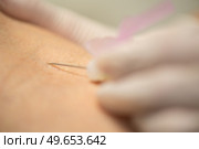 close up of syringe needle skin. Стоковое фото, агентство Ingram Publishing / Фотобанк Лори