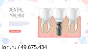 Human jaw with normal teeth and prosthesis above dental implant structure. Tooth after dental procedure. Surgical implant in oral cavity. Treatment, dentistry, oral care. Healthy tooth in human gum. Human jaw with normal healthy teeth and prosthesis in gum above structure of dental implant. Стоковая иллюстрация, агентство Ingram Publishing / Фотобанк Лори