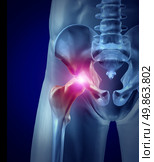 Hip pain as an inflamed joint with an x-ray medical illustration of a frontal close up macro of a human skeleton with a painful area in red as a chronic disease and injury to bone needing hip replacement surgery. Стоковое фото, агентство Ingram Publishing / Фотобанк Лори