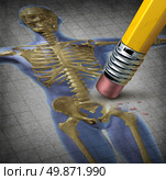 Human osteoporosis symbol of deterioration of bone tissue for a disease with medical symptoms of low skeletal mass and fragility of skeleton with an illustration of a pencil erasing the body. Стоковое фото, агентство Ingram Publishing / Фотобанк Лори