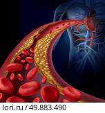 Clogged artery and atherosclerosis disease medical concept with a three dimensional human artery with blood cells that is blocked by plaque buildup of cholesterol as a symbol of arteriosclerotic vascular diseases. Стоковое фото, агентство Ingram Publishing / Фотобанк Лори