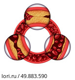 Coronary artery disease medical concept as a circular vein with gradual plaque formation resulting in clogged arteries and atherosclerosis with with a three dimensional human anatomy diagram showing the risks of cholesterol buildup. Стоковое фото, агентство Ingram Publishing / Фотобанк Лори