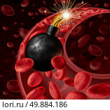 Blood circulation danger with an active inited bomb in an artery with blood cells as a concept for a human heart attack and urgent health problems caused by bad cholesterol levels and an unhealthy eatng lifestyle. Стоковое фото, агентство Ingram Publishing / Фотобанк Лори