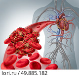 Blood clot risk and clot or thrombosis medical illustration symbol as a group of human blood cells clumped together by sticky platelets and fibrin creating a blockage in an artery or vein leading to the heart. Стоковое фото, агентство Ingram Publishing / Фотобанк Лори