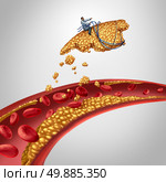 Arterial plaque surgery as a doctor cleaning an artery concept as a surgeon removing cholesterol buildup in a clogged human vein as a symbol of atherosclerosis disease medical treatment opening clogged pathways for blood circulation health. Стоковое фото, агентство Ingram Publishing / Фотобанк Лори