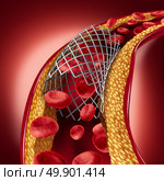 Stent implant concept as a heart disease treatment symbol with an angioplasty procedure in an artery that has cholesterol plaque blockage being opened for increased blood flow as a 3D illustration. Стоковое фото, агентство Ingram Publishing / Фотобанк Лори