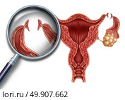 Tubal ligation reproduction medical procedure for female sterilization as a uterus with incisions on the fallopian tubes to block the egg from being fertilized as a fertility and gynecology medicine concept with 3D illustration elements. Стоковое фото, агентство Ingram Publishing / Фотобанк Лори