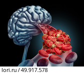Blood clot brain medical concept as 3D illustration blood cells blocked by an artery blockage thrombus causing a blockage of blood flow to the neurology anatomy in a black background. Стоковое фото, агентство Ingram Publishing / Фотобанк Лори
