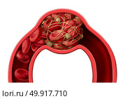 Blood clot disease symbol and thrombosis medical 3D illustration concept as a group of human blood cells clumped together by sticky platelets and fibrin creating a blockage in an artery or vein as a health disorder. Стоковое фото, агентство Ingram Publishing / Фотобанк Лори
