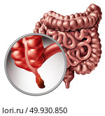 Appendicitis and appendix inflammation disease concept as a close up of human intestine anatomy as a 3D illustration. Стоковое фото, агентство Ingram Publishing / Фотобанк Лори
