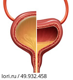 Bladder as a normal and overactive urinary organ comparison representing the involuntary loss of urine concept as a healthy and unhealthy condition with 3D illustration elements. Стоковое фото, агентство Ingram Publishing / Фотобанк Лори