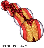 Artery disease coronary illness as a medical concept with gradual plaque formation resulting in clogged arteries and atherosclerosis with a human anatomy diagram with 3D elements. Стоковое фото, агентство Ingram Publishing / Фотобанк Лори