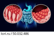 Celiac or coeliac disease as an intestine anatomy medical concept with normal villi and damaged small bowel lining as an autoimmune disorder of the digestion system with colon and stomach as a 3D illustration. Стоковое фото, агентство Ingram Publishing / Фотобанк Лори