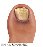 Infected fungal toe nail and feet infection or onychomycosisor tinea unguium as toenail foot disease with damaged unhealthy human anatomy in a 3D illustration style. Стоковое фото, агентство Ingram Publishing / Фотобанк Лори