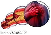 Human heart disease and chest pain from clogged arteries and artery damaged with cholesterol resulting in a cardiac arrest with 3D illustration elements. Стоковое фото, агентство Ingram Publishing / Фотобанк Лори