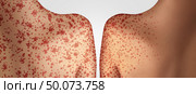 Transmission of measles concept as a deadly outbreak immunize disease and viral illness as a contagious spreading chickenpox or a skin rash in a 3D illustration style. Стоковое фото, агентство Ingram Publishing / Фотобанк Лори