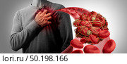 Blood clot health risk or thrombosis medical illustration symbol as a group of human blood cells clumped together by sticky platelets and fibrin as a blockage in an artery or vein leading to the heart with 3D illustration elements. Стоковое фото, агентство Ingram Publishing / Фотобанк Лори