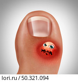Toe blister or foot wart concept as sore corn or painful feet skin  representing a foot infection or feet injury in a 3D illustration style. Стоковое фото, агентство Ingram Publishing / Фотобанк Лори