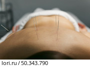 acupuncture process client. Стоковое фото, агентство Ingram Publishing / Фотобанк Лори
