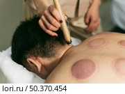 suction cups therapy session close up. Стоковое фото, агентство Ingram Publishing / Фотобанк Лори