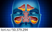 Sinus Infection and Sinusitis illness as a nasal cavity blockage disease with a congested nose full of mucus or pus in a 3D illustration style. Стоковое фото, агентство Ingram Publishing / Фотобанк Лори