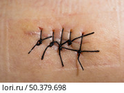 Close-up picture of a scar with stitch. Стоковое фото, агентство Ingram Publishing / Фотобанк Лори