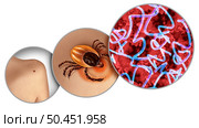 Lyme disease and Deer tick crawling on skin as a bacterial infection health danger as the bite of a parasite causing an illness with bacteria with 3D illustration elements. Стоковое фото, агентство Ingram Publishing / Фотобанк Лори
