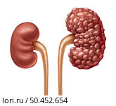 Chronic Kidney Disease or CKD as Human kidneys concept as one healthy and polycystic disease with cysts as anatomy of the urinary system on with a white background in a 3D illustration style. Стоковое фото, агентство Ingram Publishing / Фотобанк Лори