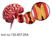 Atherosclerosis And Stroke as a Brain disorder caused by blood cells blocked by fat and cholesterol build up as an artery blockage and hardening of the arteries causing a blockage of blood flow anatomy with 3D render elements. Стоковое фото, агентство Ingram Publishing / Фотобанк Лори