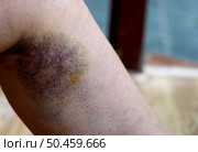 Bruises in the leg area after a minor fall, a visible discoloration and swelling indicate soft tissue damage recorded indoors in daylight. Стоковое фото, фотограф Вербицкая Светлана / Фотобанк Лори