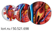 Bypass surgery and Coronary Artery Grafting or CABG as an obstruction of plaque in the coronary artery or arteries as a vein from a leg that is grafted to a heart bypassing a blood circulation blockage in a 3D illustration style. Стоковое фото, агентство Ingram Publishing / Фотобанк Лори
