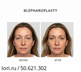 Блефаропластика. Стоковое AI-изображение, AI-художник Olga Dmitrieva / Фотобанк Лори