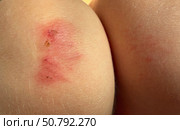 Close-up view of a scraped knee with visible abrasions and redness. Concept of: Skin injury. Стоковое фото, фотограф Ольга Петрова-Апостолова / Фотобанк Лори