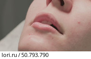 The lip enhancement procedure is currently underway, improving beauty and aesthetics. Стоковое видео, видеограф Olesia Kondrateva / Фотобанк Лори