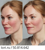 Changes in skin tone during a dermatological treatment session on a patient’s face. Стоковое AI-изображение, AI-художник Татьяна  Бральнина / Фотобанк Лори