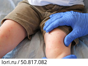 Doctor examining child with bodily red rash. Kid allergy closeup. Little baby scratches an eruption. Nurse applies special cream to atopic skin. Dermatitis, irritation, hive. Pruritus. Mosquito bites. Стоковое фото, фотограф Марина Демидюк / Фотобанк Лори