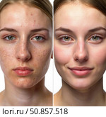 Before And After Emulsion Application Shows Reduced Redness And Acne. Generative AI. Стоковое AI-изображение, AI-художник Roman Zavorotny / Фотобанк Лори