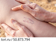 A woman examines blue spider veins on her leg. Telangiectasias, dilated capillaries showing through the skin. Стоковое фото, фотограф Коханова Наталья / Фотобанк Лори