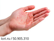 Human Hands with Painful Rash, Red Spots Blisters on the Skin. Health Problem. Monkeypox Disease Symptoms. Male Patient Arms with Monkey Pox. Close Up. Dengue Fever Infection, MPOX. Herpes, Pox Virus. Стоковое AI-изображение, AI-художник Марина Демидюк / Фотобанк Лори