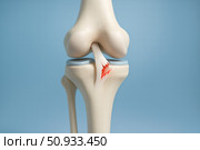 Detailed Anatomical Structure of a Human Knee Joint Featuring a Torn Ligament Highlighted in Red for Enhanced Visualization and Understanding. Стоковое AI-изображение, AI-художник Башкирова Анна / Фотобанк Лори