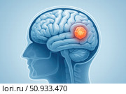 Illustration of a Human Brain with an Emphasized Tumor, Representing Neurological Health and Medical Concerns in a Scientific Context. Стоковое фото, фотограф Башкирова Анна / Фотобанк Лори