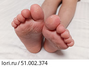 Dry feet peeling skin on feet. Air allergy, chemical allergy. Dermatitis. Eczema. Dyshidrosis. Baby feet. White background. Стоковое фото, фотограф Екатерина Топорова / Фотобанк Лори