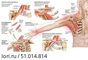 Medical illustration detailing thoracic outlet syndrome. Стоковое фото, фотограф Stocktrek Images, Inc. / ТАСС / Фотобанк Лори