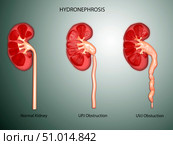 Hydronephrosis condition of the kidney. Стоковое фото, фотограф Stocktrek Images, Inc. / ТАСС / Фотобанк Лори