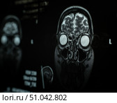 Close-up of magnetic resonance imaging of the human brain. Стоковое фото, фотограф Михаил Решетников / Фотобанк Лори