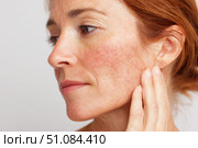 Sensitive skin. Woman scratches cheek with red rash, allergy symptom. Skin irritation, dermatitis, itchy skin problem. Face affected with Allergic reaction. Person suffering from itching, scratching. Стоковое AI-изображение, AI-художник Марина Демидюк / Фотобанк Лори